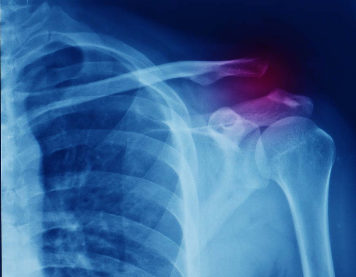 Acromioclavicular Joint (ACJ) Injuries - Sports Medicine Information