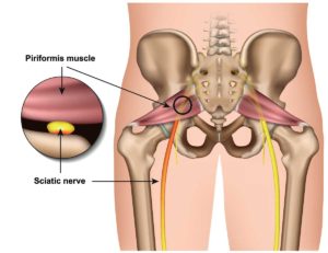 Sit Bone Pain  Ischial Bursitis Treatment in India